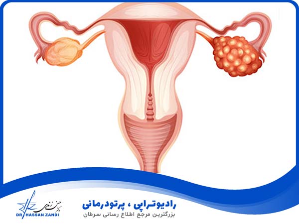 انواع سرطان در ایران