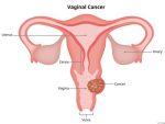 سرطان واژن